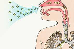 	A diagram showing aspergilloma affecting human lung