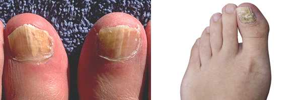 Composite image. Onychomycosis due to Trichophyton rubrum, right and left great toe. Tinea unguium.