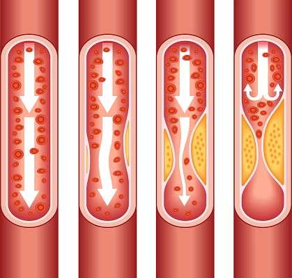 As plaque builds up in the arteries of a person with heart disease, the inside of the arteries begins to narrow, which lessens or blocks the flow of blood.