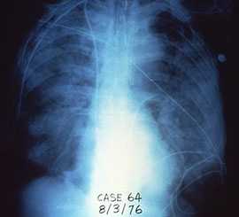 x-ray of chest