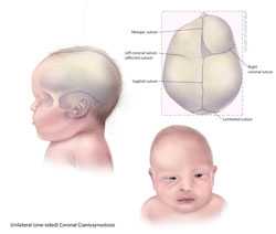 Craniosynostosis