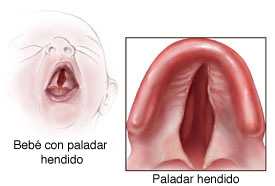 bebé con paladar hendido