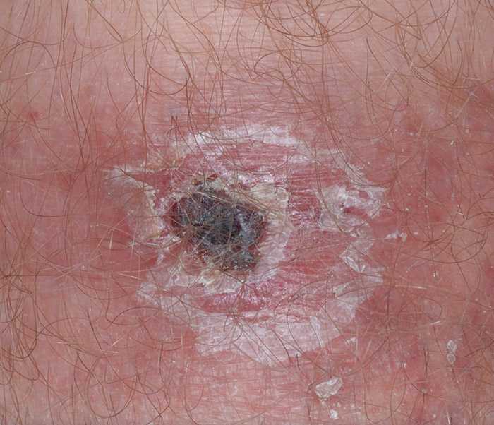 Eschar on patient with R. parkeri rickettsiosis.