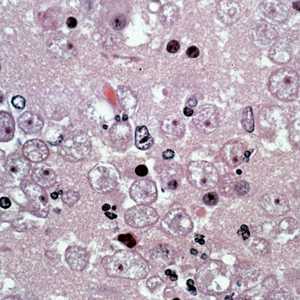 Several trophozoites of B. mandrillaris in brain tissue, stained with hematoxylin and eosin (H&E).