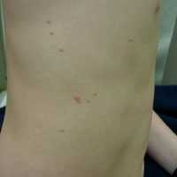 Typical molluscum lesions on the torso of a child. Typical lesions are approximately 3-5 mm in diameter. Image courtesy Dave Bray, MD, Walter Reed Army Medical Center.