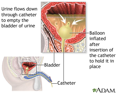 Bladder catheterization, male Bladder catheterization, male