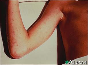 Rocky mountain spotted fever on the arm Rocky mountain spotted fever on the arm