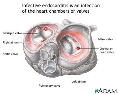 Infective endocarditis Infective endocarditis