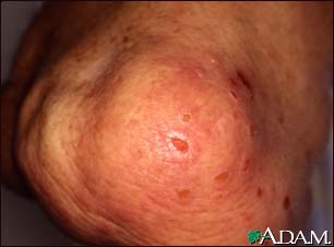 Dermatitis, herpetiformis on the knee Dermatitis, herpetiformis on the knee