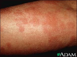 Hives (urticaria) on the arm Hives (urticaria) on the arm