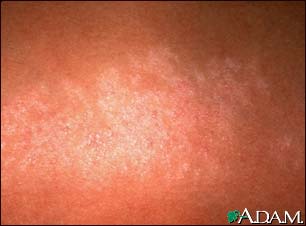 Lichen striatus - close-up Lichen striatus - close-up