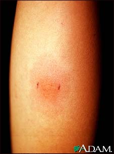 Positive PPD skin test Positive PPD skin test