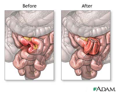 Before and after small intestine anastomosis Before and after small intestine anastomosis