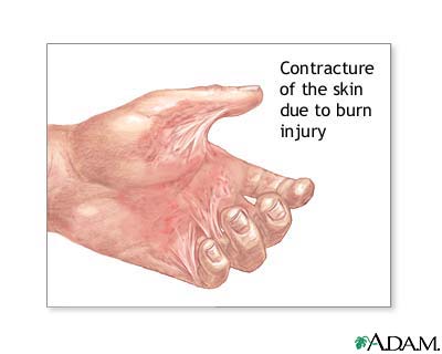Contracture deformity Contracture deformity
