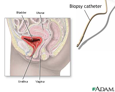 Ureteral biopsy Ureteral biopsy