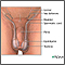 Testicular torsion repair - series