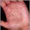 Hyperlinearity in atopic dermatitis