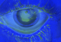 Airbag-corneal-abrasion1.png