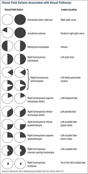 File:Visual-field-defect.jpg