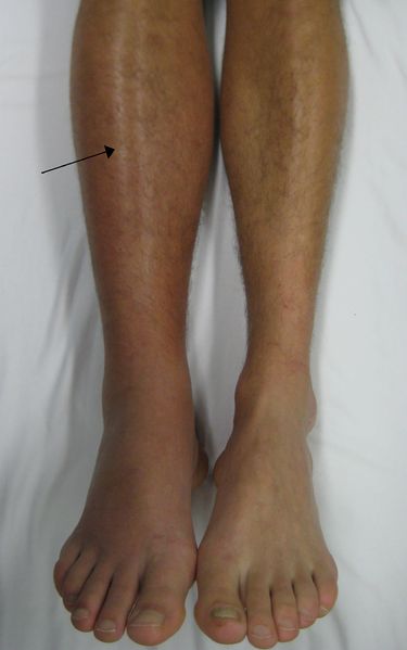 File:Deep vein thrombosis of the right leg.jpg