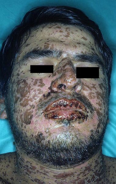 File:Stevens-johnson-syndrome.jpg
