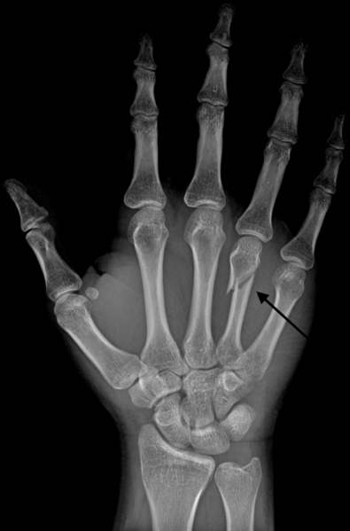 File:Neck Fracture of the Fourth Metacarpal Bone.png