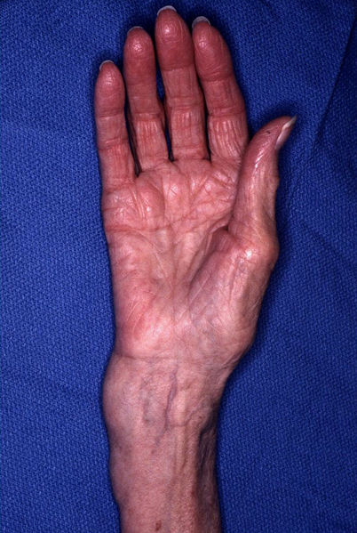 File:Distalradiusfracture.jpg