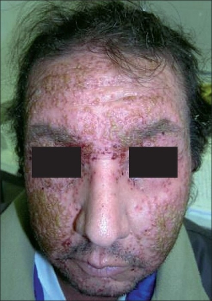 File:Eczema Herpeticum picture.png