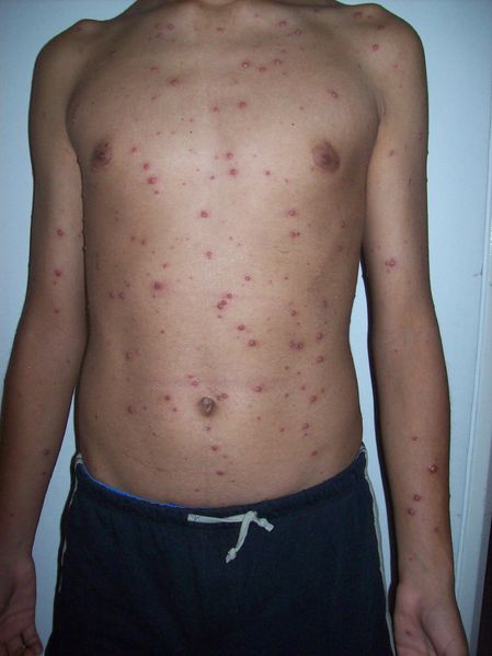 File:Varicela Rash.jpg
