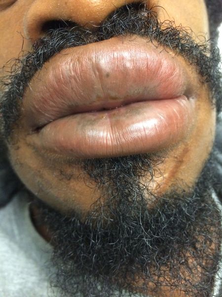 File:Angioedema post lisinopril use 2014-12-08 12-35.jpg