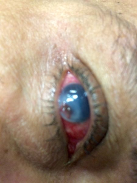 File:Endophthalmitis from retained foreign body 2015-02-03 08-16.jpg