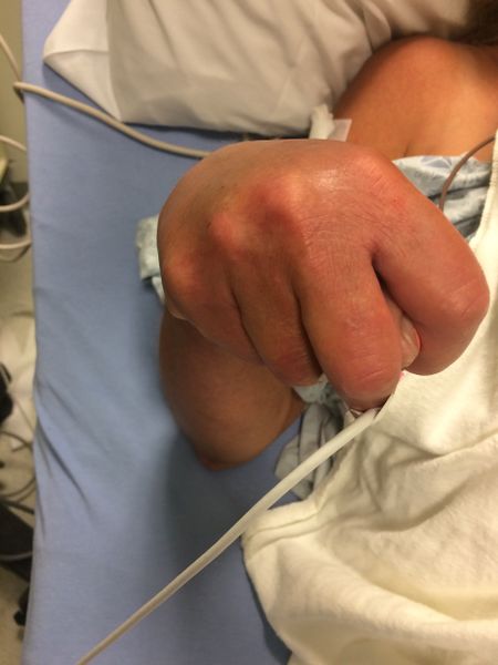 File:Hypocalcemia spasm.jpg