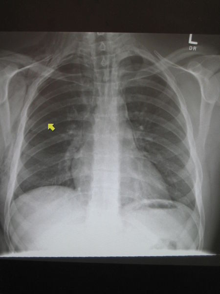 File:PneumoMediastinum2008.jpg