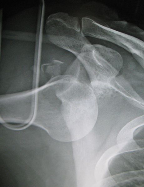 File:Inferiourdislocation.jpg