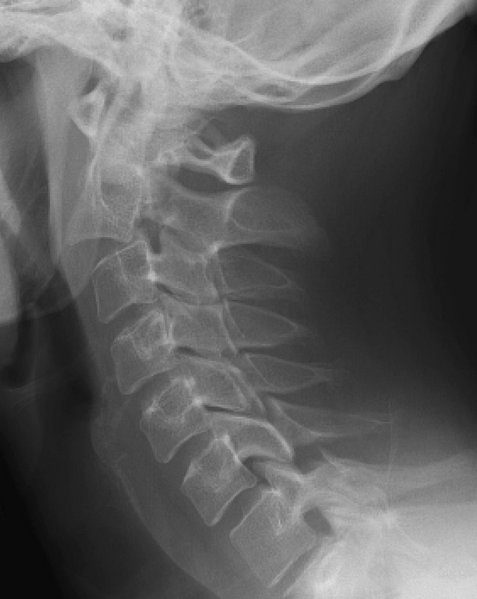 File:Hangman fracture.png