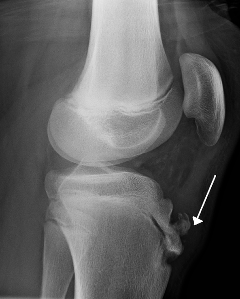 File:Osgood-schlatter-xray.png
