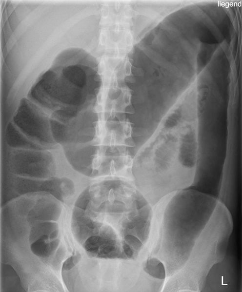 File:Toxisches Megacolon bei Colitis ulcerosa.jpg