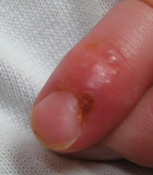 File:Herpetic whitlow in young child.jpg