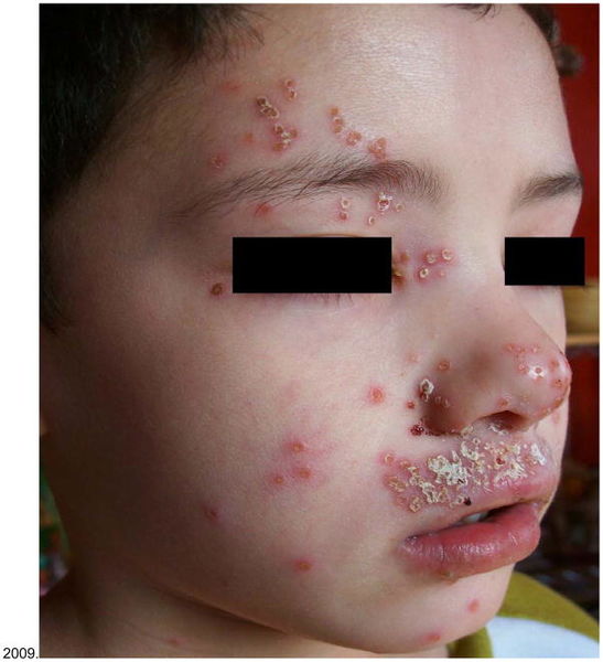 File:Eczema Herpticum picutre 2.jpg