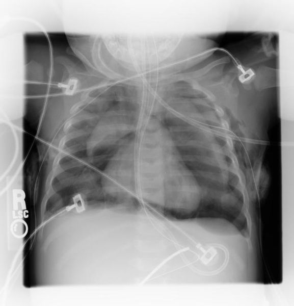 File:Pneumomediastinum-003.jpg