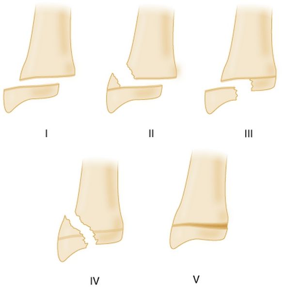 File:Salter Harris.jpg