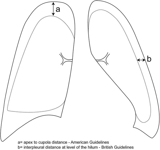 File:Pneumothorax measurement.jpg