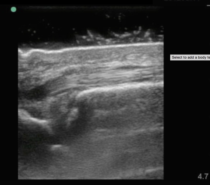 File:Tendon anisotrophy on left of screen.png