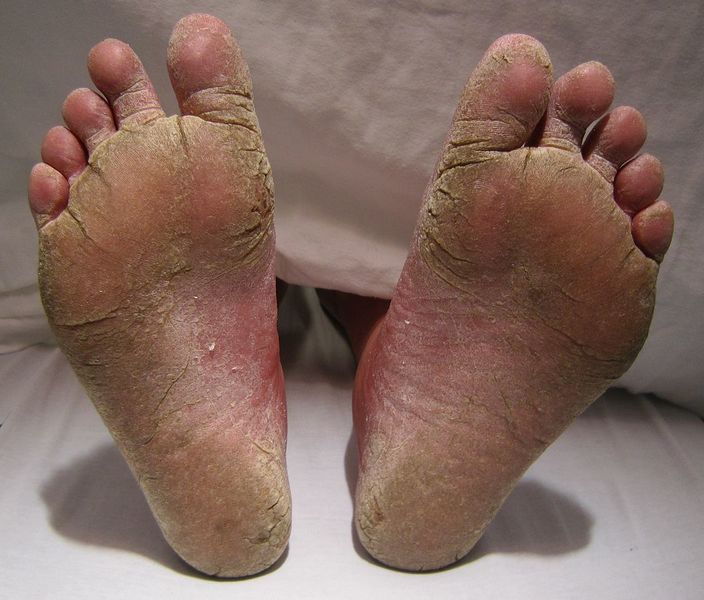 File:FeetFungal.jpg