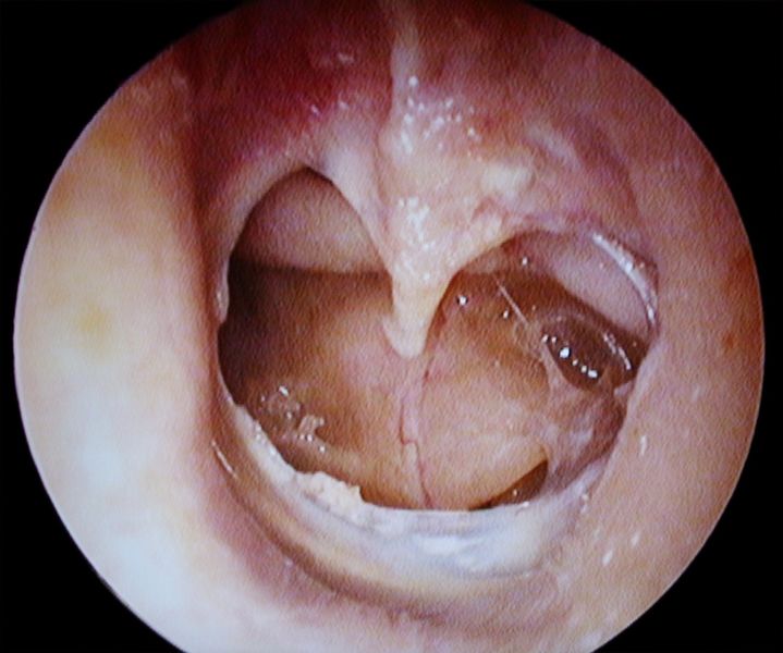 File:PerforationTympan.jpg