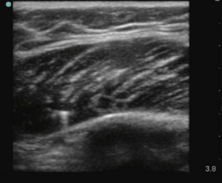 File:Needle tip in muscle tissue.png