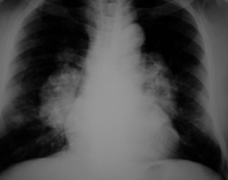 File:SarcoidXray.png