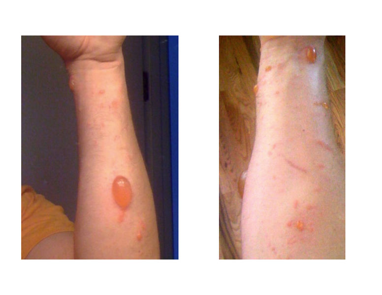 File:Urushiol induced contact dermatitis.jpg