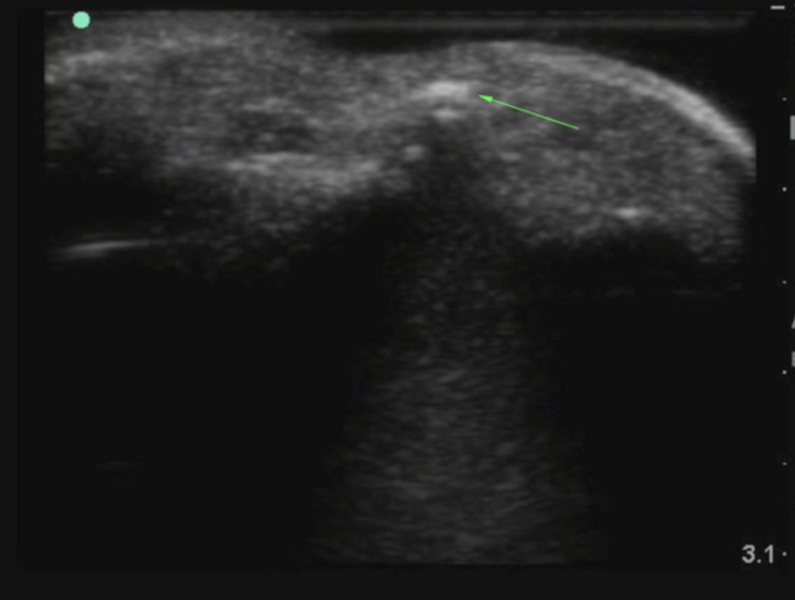 File:Foreign body in finger.png