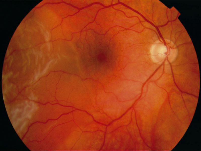 File:A Retinal Detachment.jpg